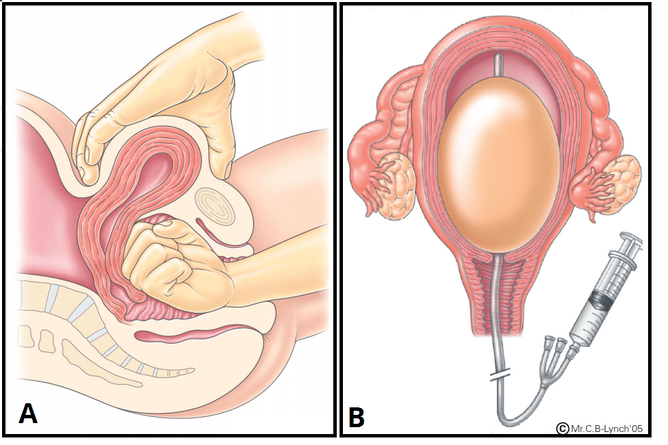 manual reposition prolapse after pregnancy