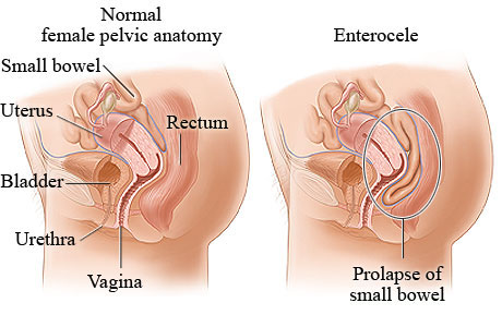 manual reposition prolapse after pregnancy