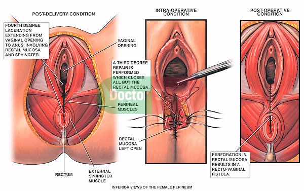 manual reposition prolapse after pregnancy